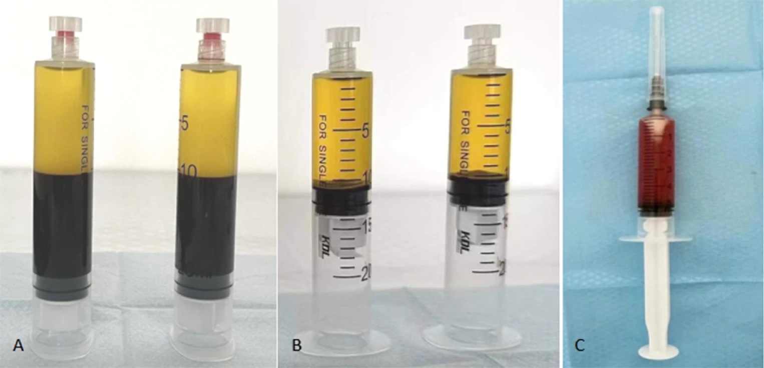 Gel PRP kết hợp với siêu âm – Giải pháp sinh học mới cho rách cơ Supraspinatus