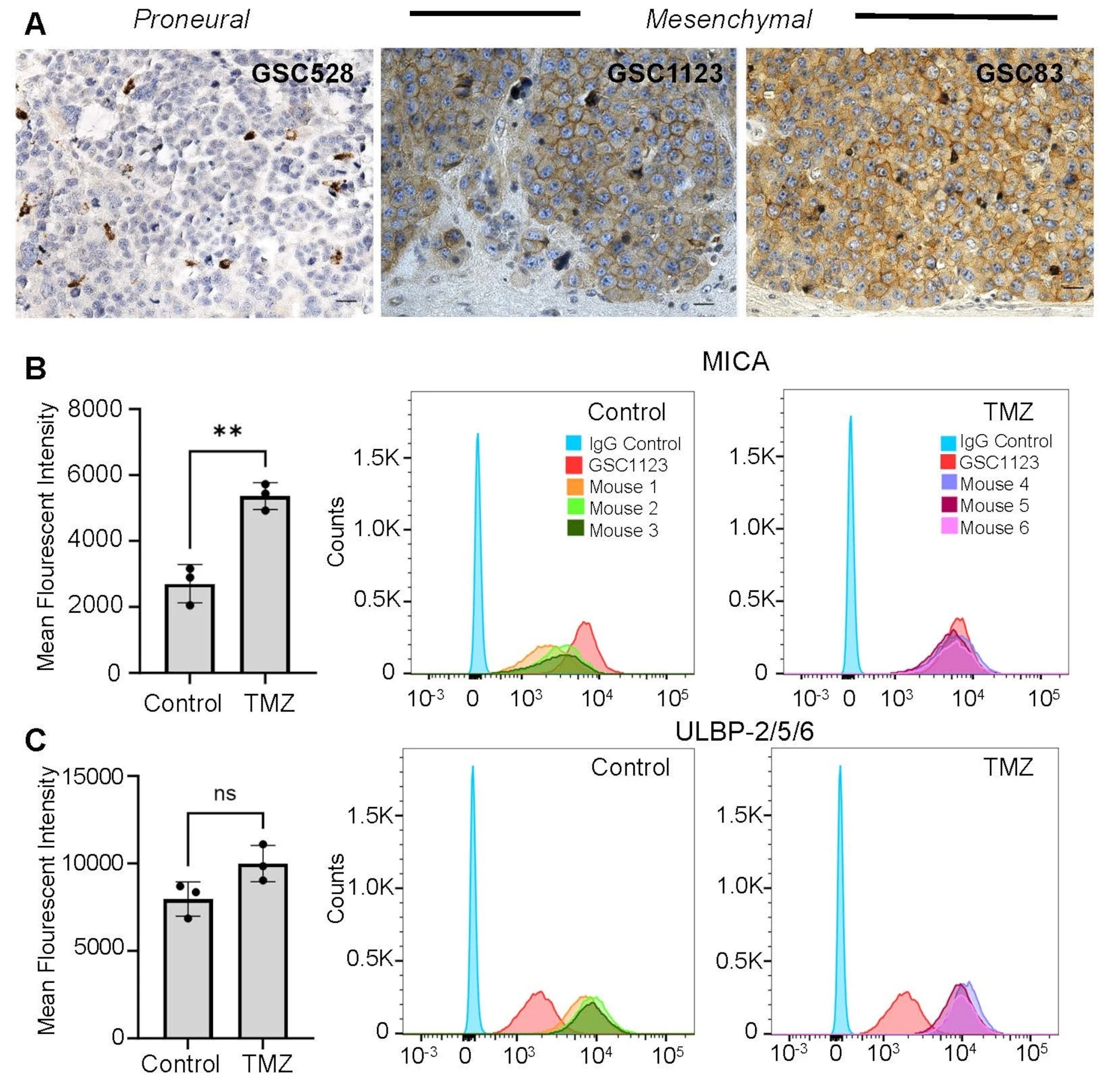 Liệu pháp miễn dịch – hóa trị bằng tế bào NK được áp dụng đúng thời điểm có thể loại bỏ và ngăn ngừa tái phát khối u não do tế bào gốc u nguyên bào thần kinh dạng trung mô